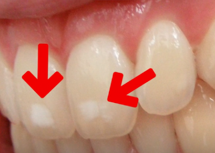  Răng Xuất Hiện Đốm Trắng - Cảnh báo bệnh lý về răng đừng coi thường