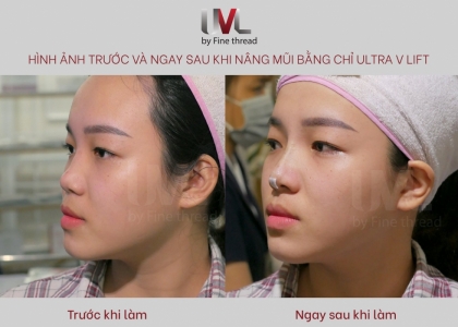 Trải nghiệm nâng mũi bằng chỉ Ultra V Lift Tại Dermaster Việt Nam