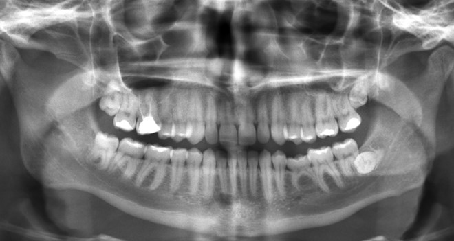 Chụp Xquang hàm gửi cho bác sĩ trước khi nhổ răng số 8