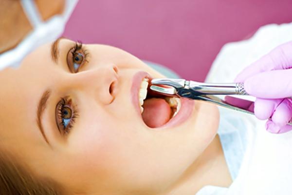 Quy trình nhổ răng khôn số 8 
