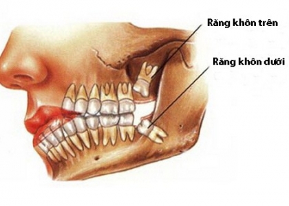  Kinh nghiệm nhổ răng khôn số 8 có đau và nguy hiểm không Webtretho